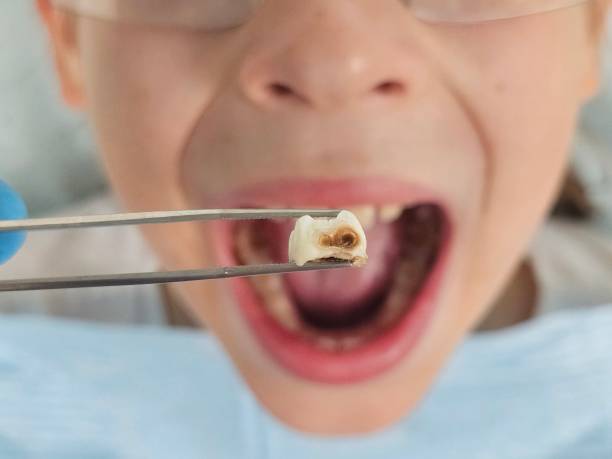 Best Knocked-Out Tooth (Avulsed Tooth) Treatment in Marion, NC