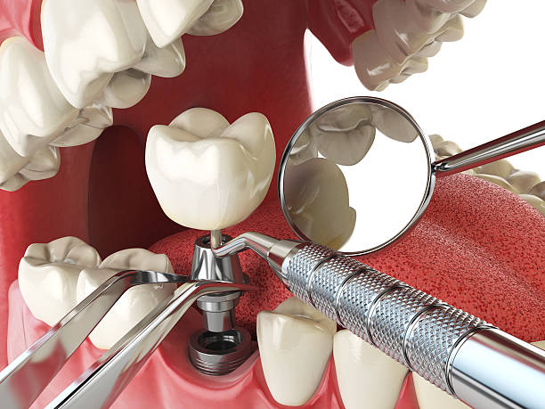Best Emergency Dental Care for Sports Injuries in Marion, NC